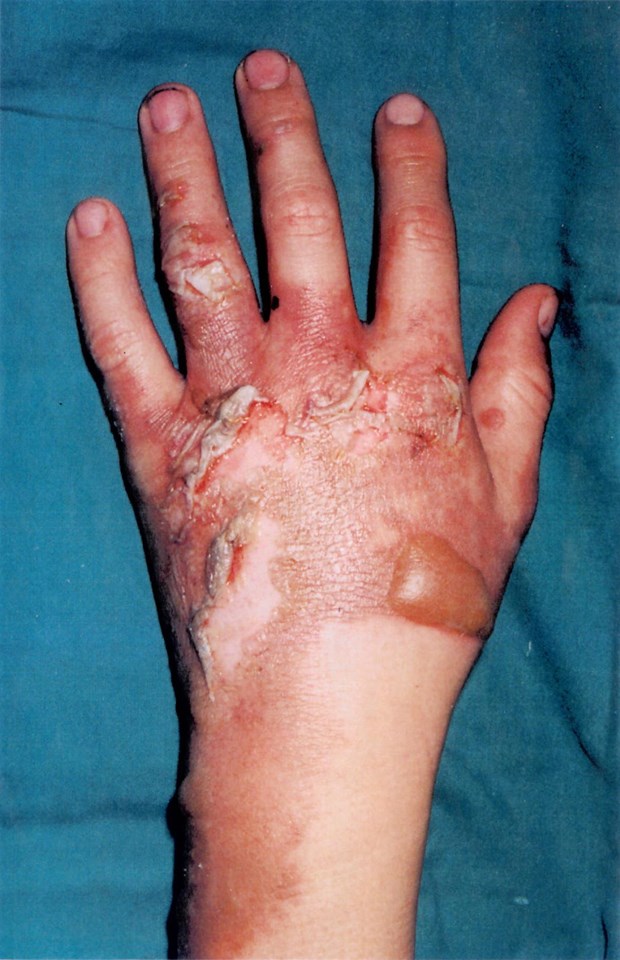 Hand burns suffered by Nathan Wood aged 12 after coming into contact with overhead wires on the railway: Burns suffered by Nathan Wood aged 12 after coming into contact with overhead wires on the railway