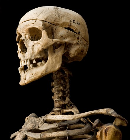 Skeleton of William Burke. Image copyright Anatomical Museum collection, University of Edinburgh (2)