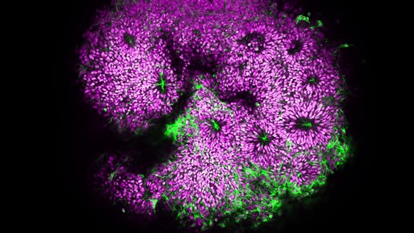 La maladie d’Alzheimer pourrait trouver son origine dans le neurodéveloppement: bannière-3