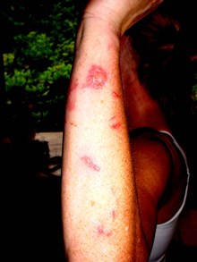 Burns on arm ©King County Noxious Weed Control Program USA