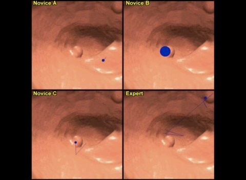 The image below is the CTC image of the scan path of three trainee radiologists and one expert looking for cancer in the bowel from a virtual fly-through of the colon created from CT colonography data.