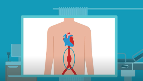 Abdominal aortic aneurysm (AAA) screening