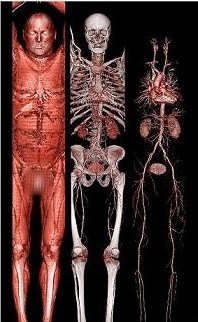 World’s most advanced CT scanner illuminates the body’s hidden structures : sc_upload_file_somatom_definition_1343538.jpg