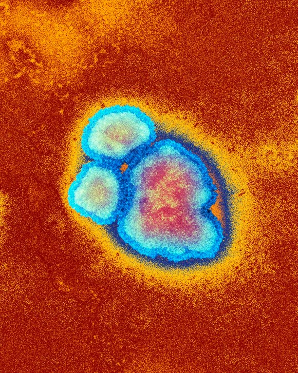 Public reminded to check they are up-to-date with MMR vaccine following measles cases in Surrey & Sussex: Measles- 60350