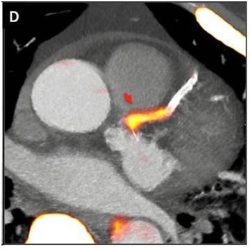 PET-CT from Siemens Healthcare used in ground-breaking heart disease research: innovations-in-pet-ct-full-size.jpg