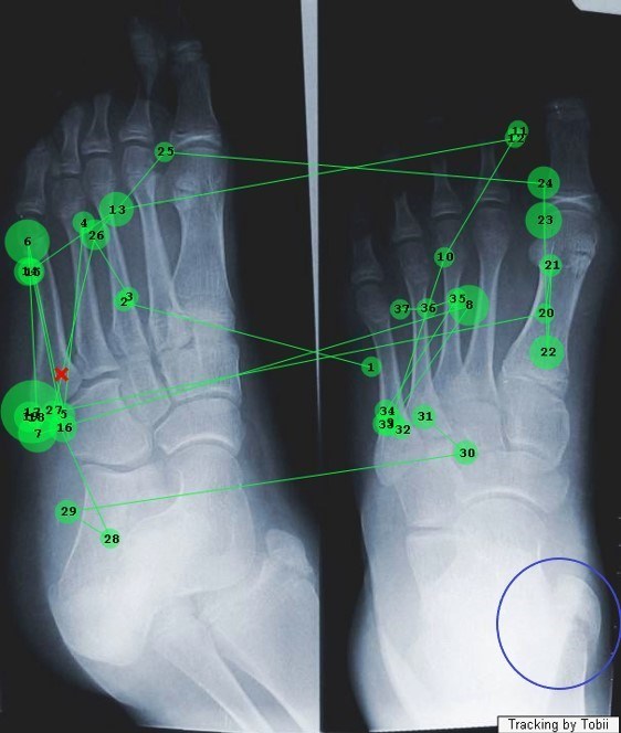 The image below shows the scan path of a radiographer looking for fractures. The red cross is where they think there is a fracture, but this is wrong. They have actually missed the fracture in the blue circle.