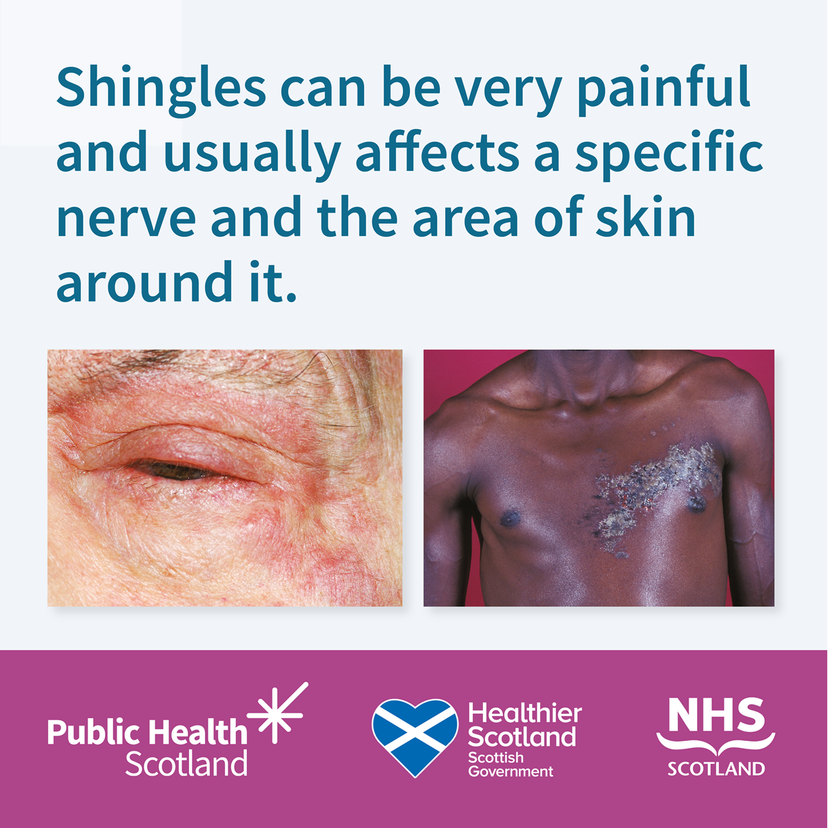 Shingles Vaccine (Static 1B) - September 2024