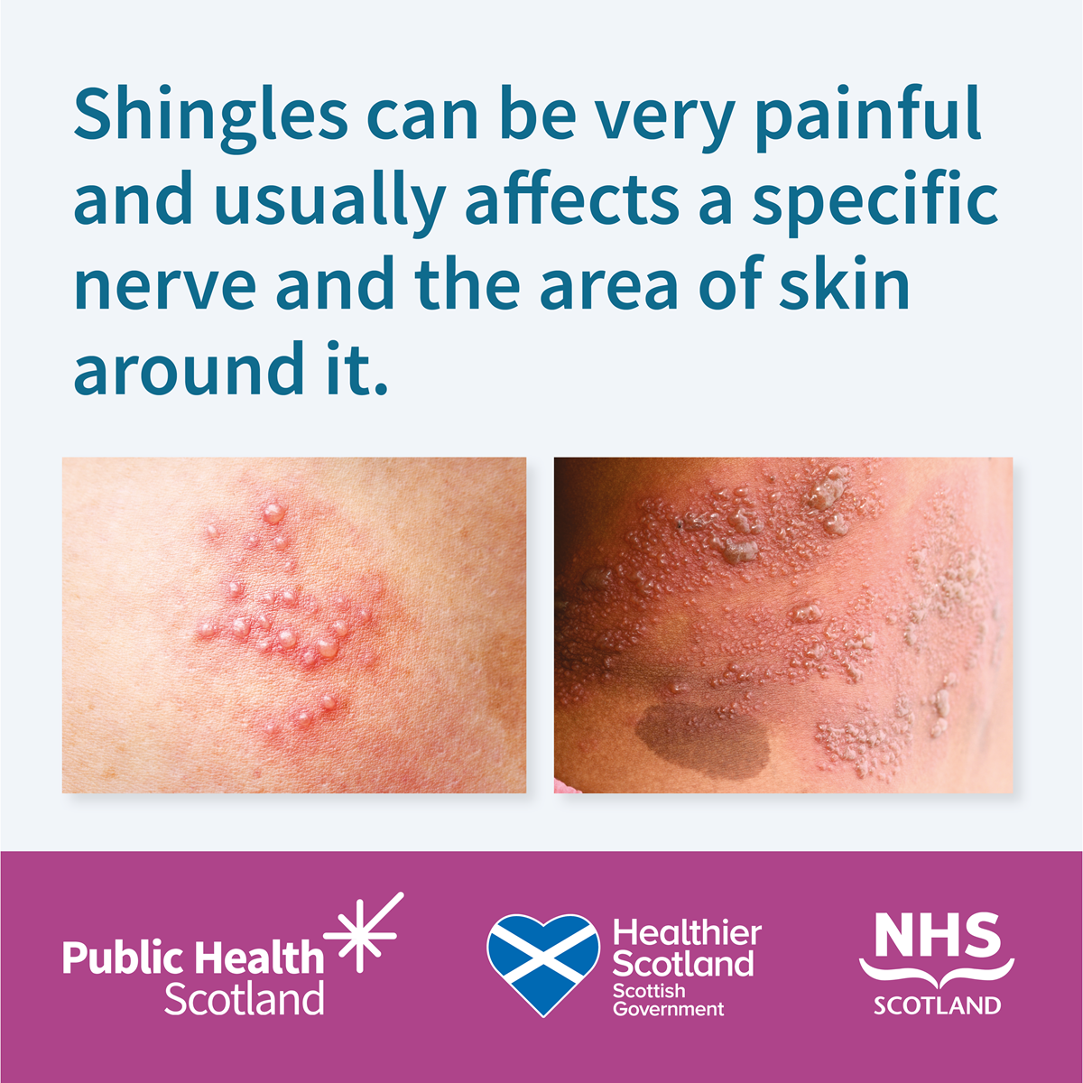 Shingles Vaccine (Static 1A) - September 2024