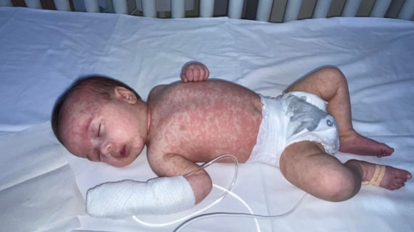 UKHSA warns West Midlands families of back to school measles surge: Baby Ezra 04