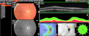 Retina imagery courtesy of Cameron Optometry: Retina imagery courtesy of Cameron Optometry