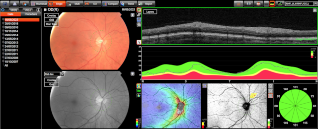 Retina imagery courtesy of Cameron Optometry