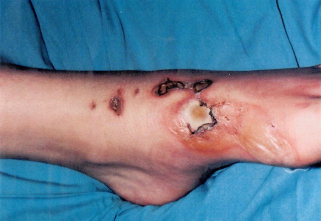 Foot burns suffered by Nathan Wood aged 12 after coming into contact with overhead wires on the railway