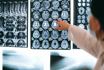Brain scan stock image