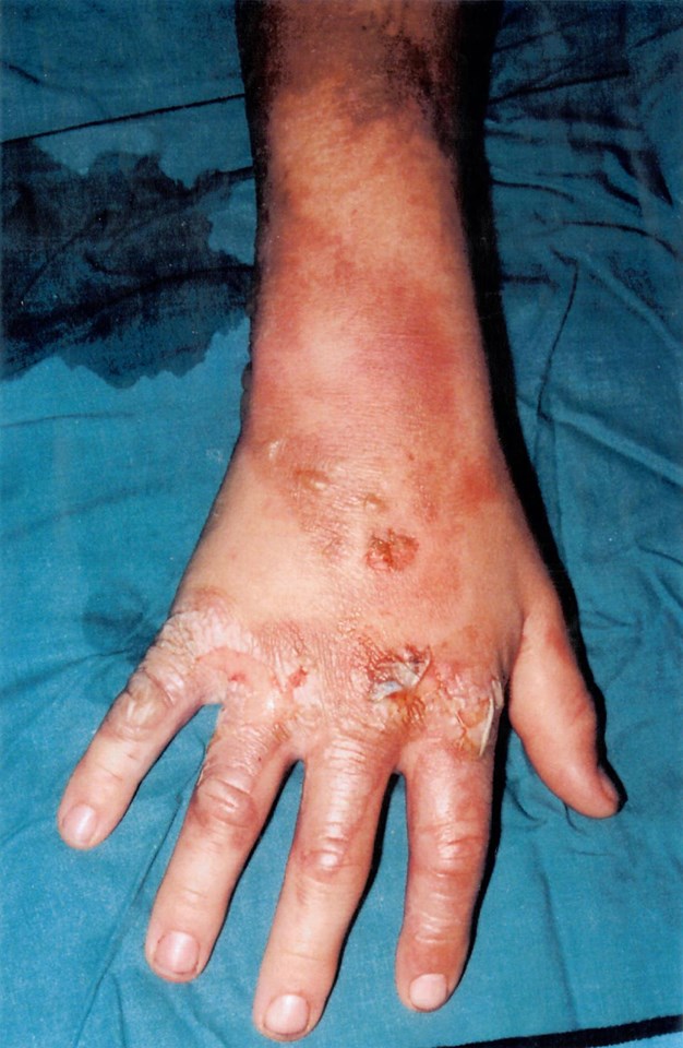 Hand burns suffered by Nathan Wood aged 12 after coming into contact with overhead wires on the railway: Burns suffered by Nathan Wood aged 12 after coming into contact with overhead wires on the railway