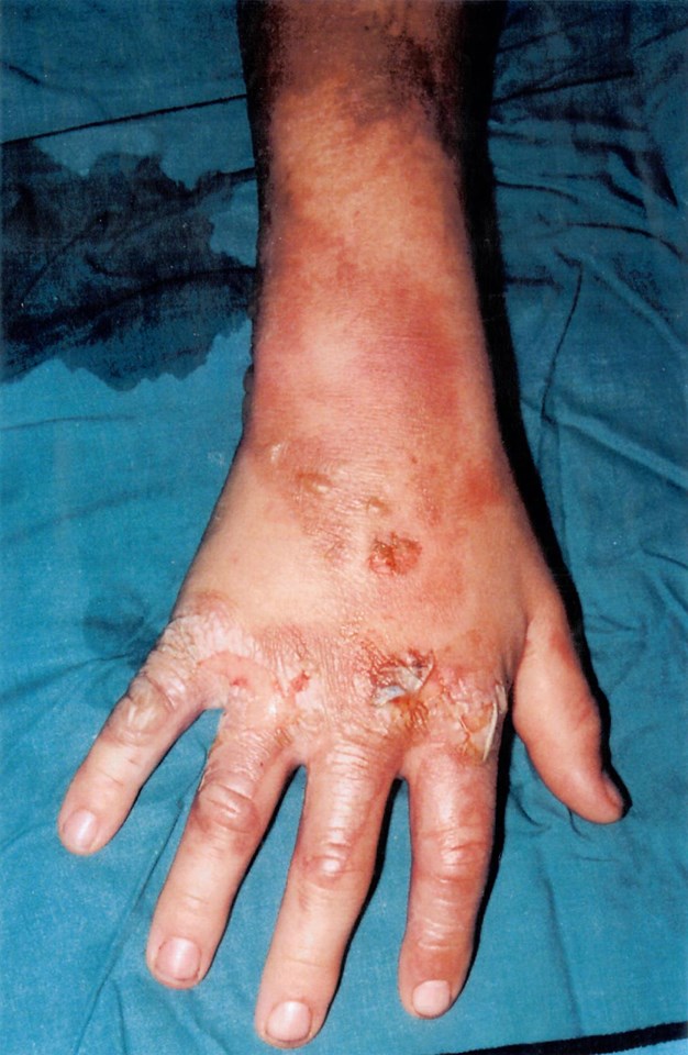 Hand burns suffered by Nathan Wood aged 12 after coming into contact with overhead wires on the railway